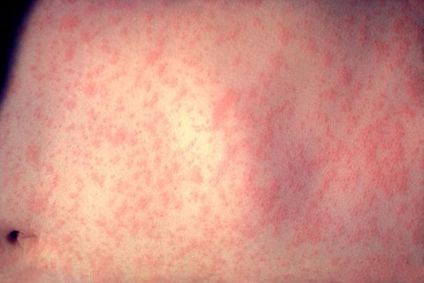 File photo of the skin of a patient after three days of measles infection.Heinz F. Eichenwald, MD CDC
